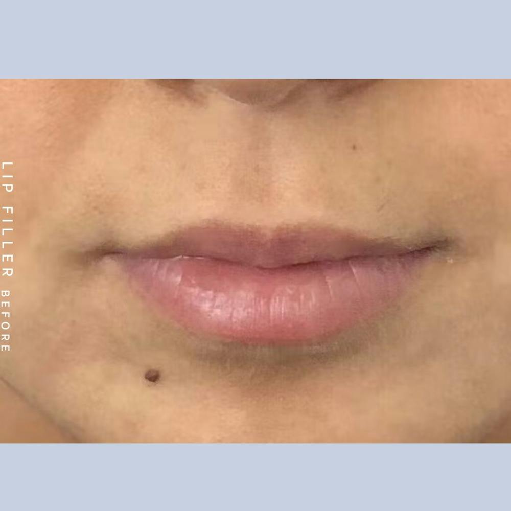 Lip filler before photo