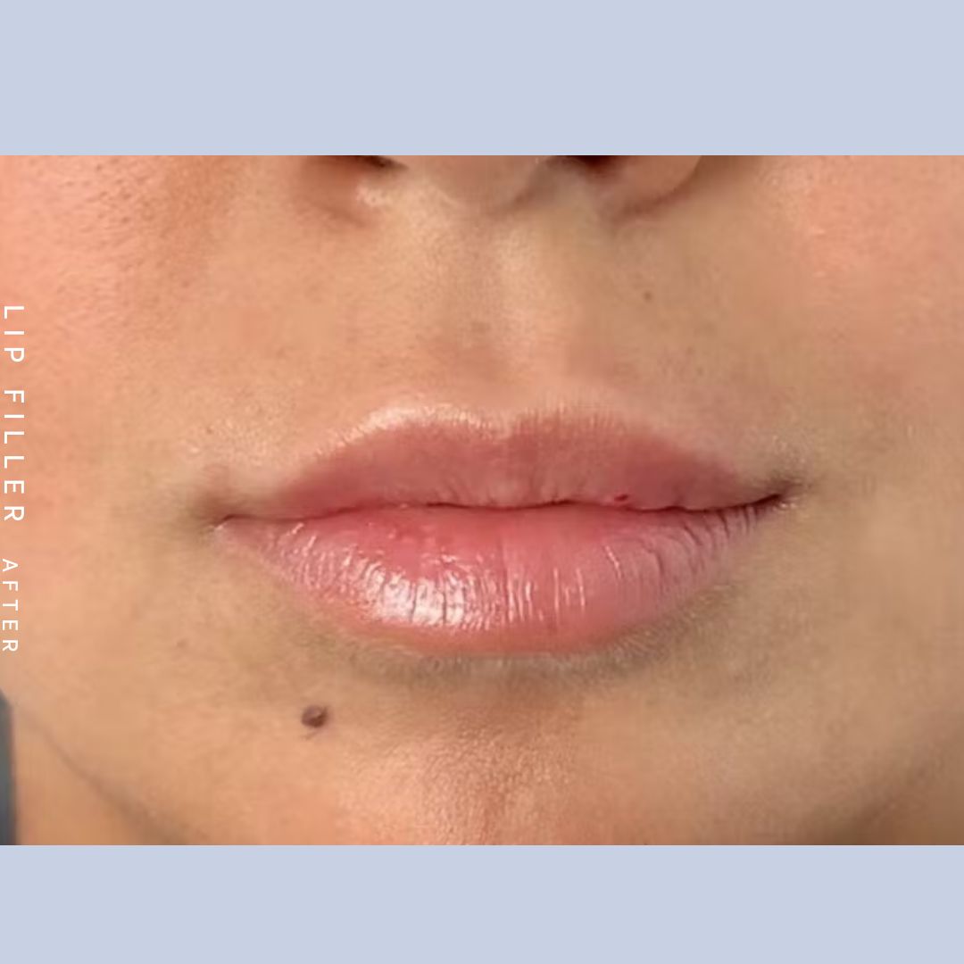 Lip filler after photo