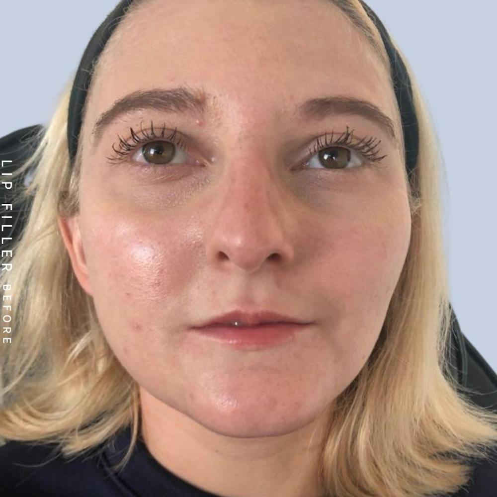 Lips Before & After Gallery - Patient 121418559 - Image 1