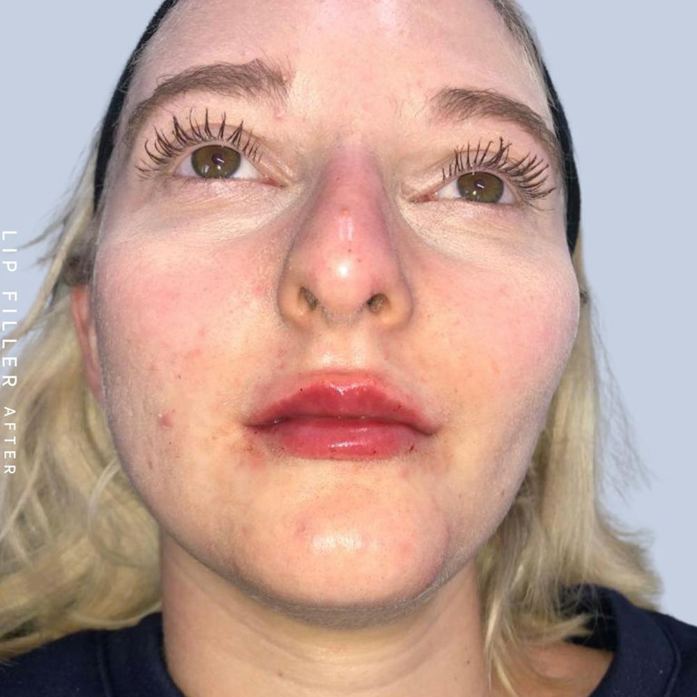 Lips Before & After Gallery - Patient 121418559 - Image 2