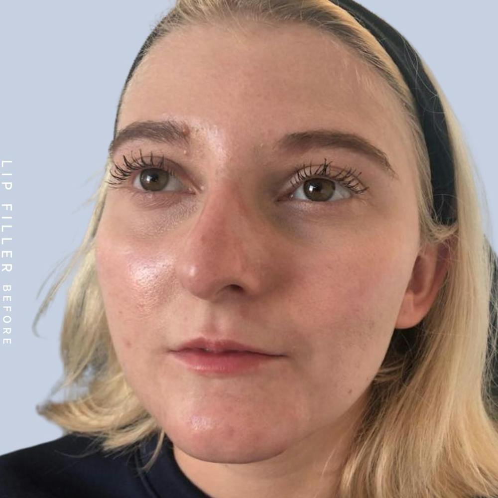 Lips Before & After Gallery - Patient 121418559 - Image 3