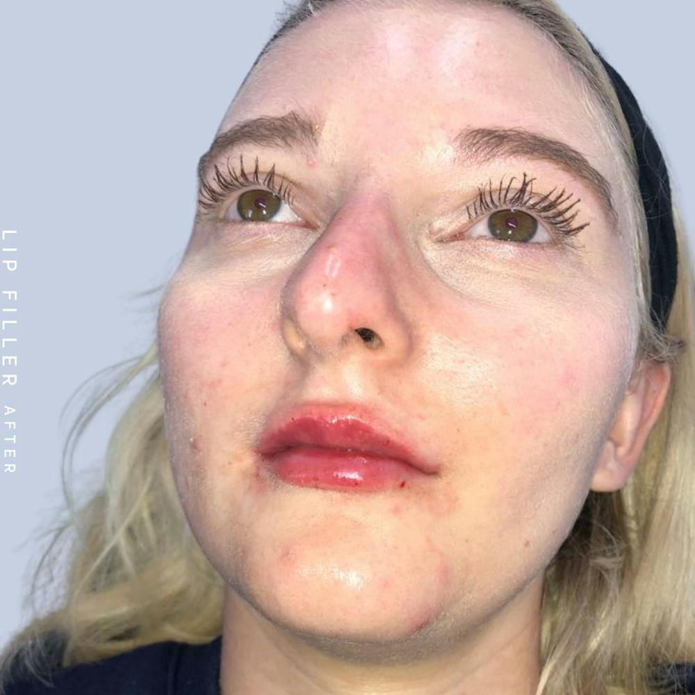 Non-Surgical Lips Before & After Gallery - Patient 121418559 - Image 4