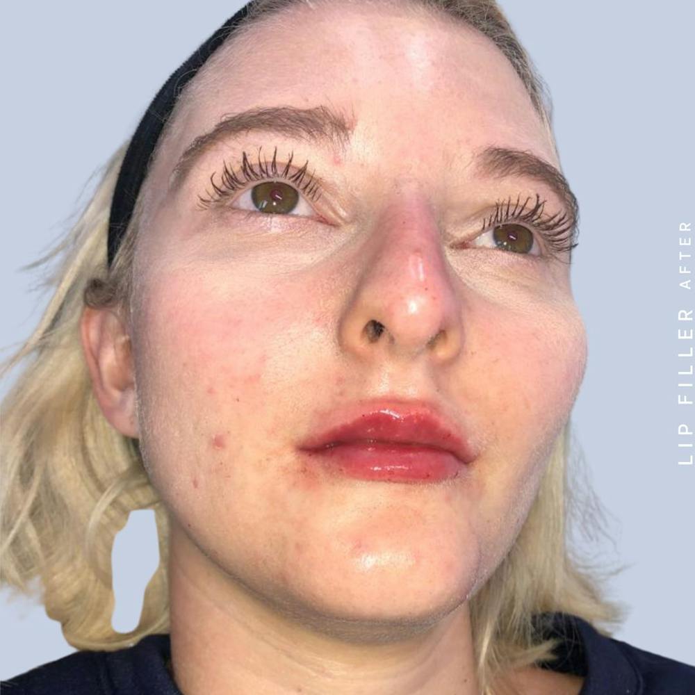 Lips Before & After Gallery - Patient 121418559 - Image 6