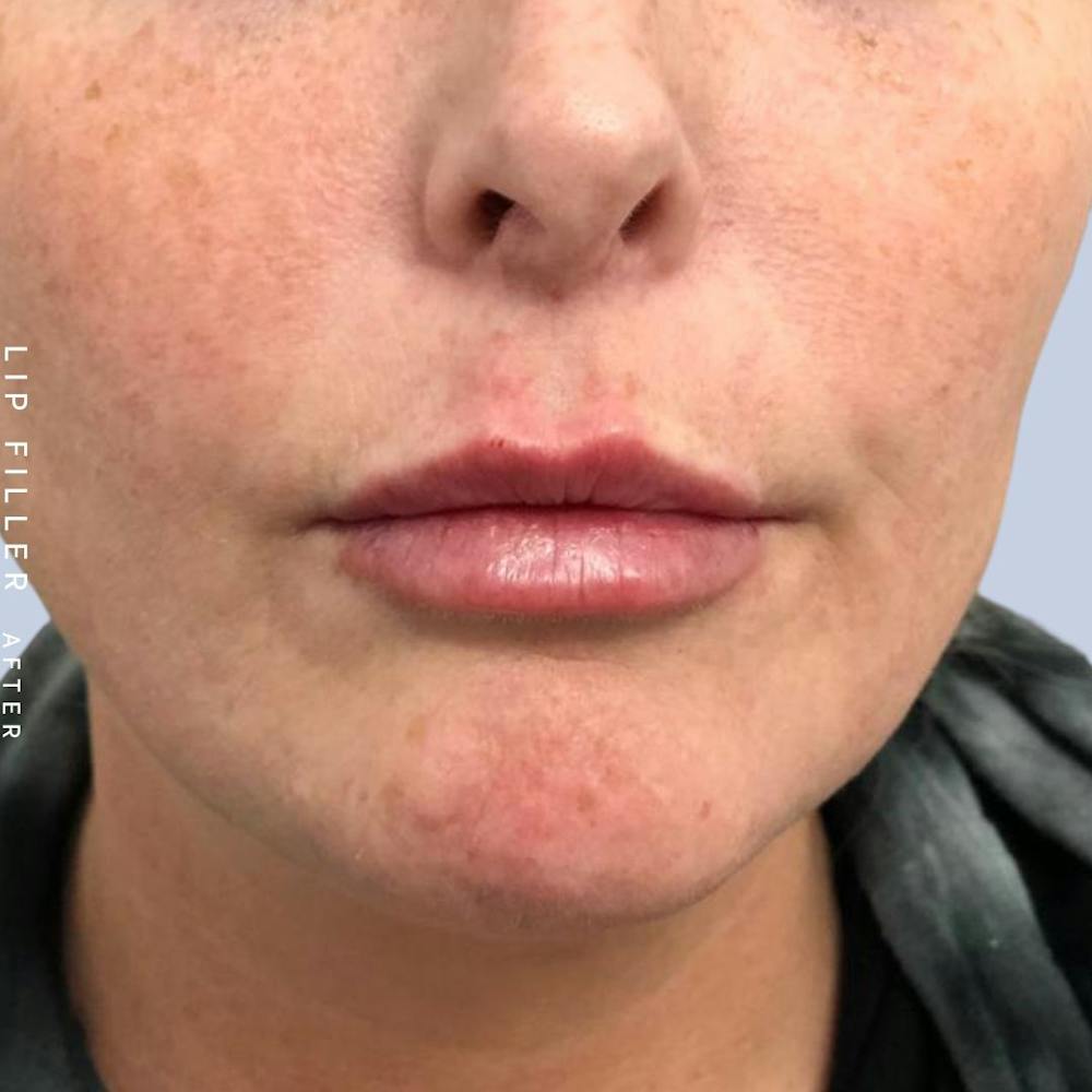 Non-Surgical Lips Before & After Gallery - Patient 121418619 - Image 2