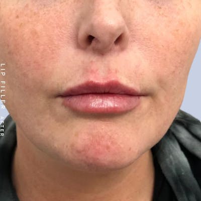 Non-Surgical Lips Before & After Gallery - Patient 121418619 - Image 2