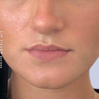 Non-Surgical Lips Before & After Gallery - Patient 108744405 - Image 1