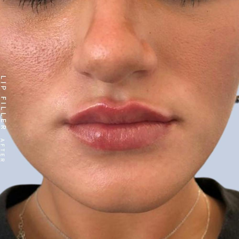 Non-Surgical Lips Before & After Gallery - Patient 108744405 - Image 2