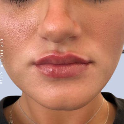 Non-Surgical Lips Before & After Gallery - Patient 108744405 - Image 2
