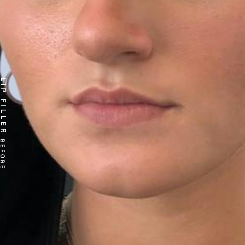 Non-Surgical Lips Before & After Gallery - Patient 108744405 - Image 3
