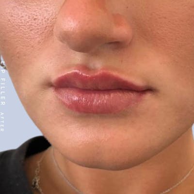 Lips Before & After Gallery - Patient 108744405 - Image 4