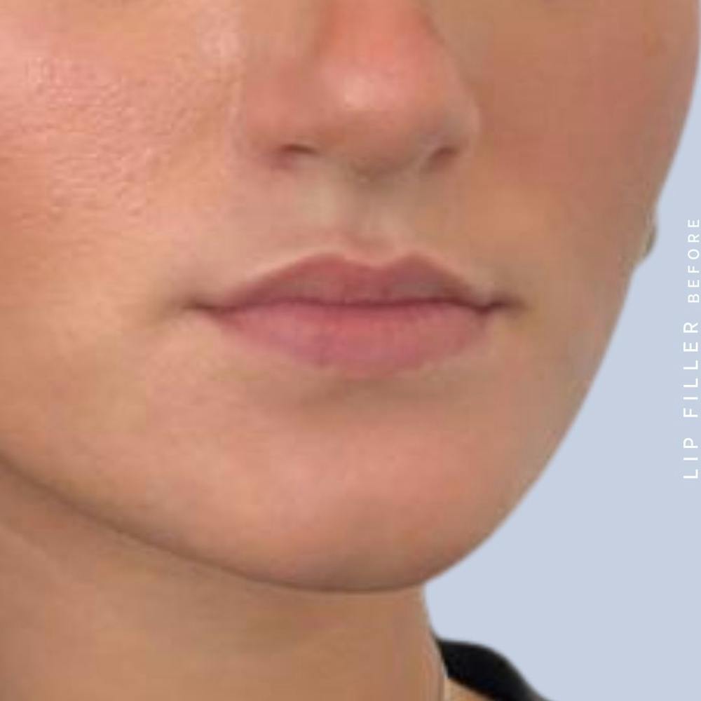Lips Before & After Gallery - Patient 108744405 - Image 5