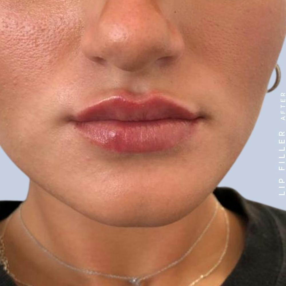 Non-Surgical Lips Before & After Gallery - Patient 108744405 - Image 6