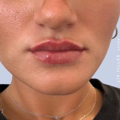 Non-Surgical Lips Before & After Gallery - Patient 108744405 - Image 6