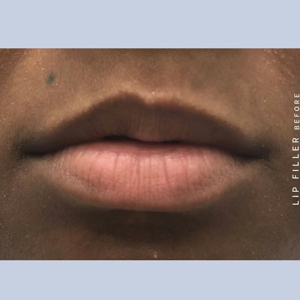 Non-Surgical Lips Before & After Gallery - Patient 108744406 - Image 1