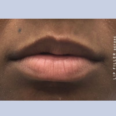Non-Surgical Lips Before & After Gallery - Patient 108744406 - Image 1