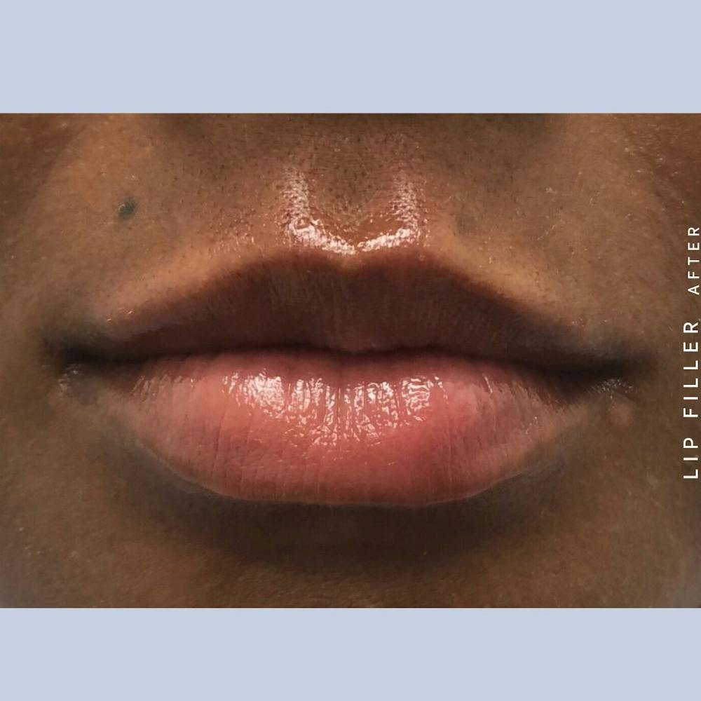 Non-Surgical Lips Before & After Gallery - Patient 108744406 - Image 2