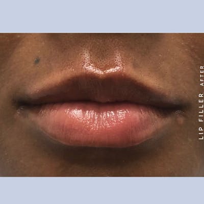 Non-Surgical Lips Before & After Gallery - Patient 108744406 - Image 2