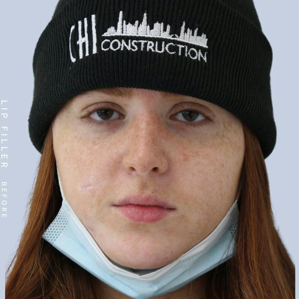 Non-Surgical Lips Before & After Gallery - Patient 108744407 - Image 1
