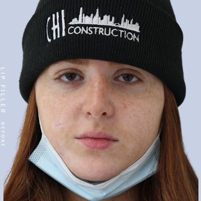 Non-Surgical Lips Before & After Gallery - Patient 108744407 - Image 1