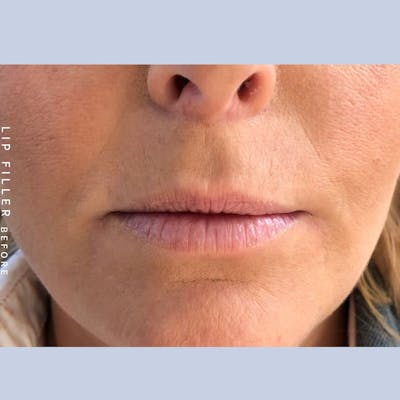 Non-Surgical Lips Before & After Gallery - Patient 108744408 - Image 1