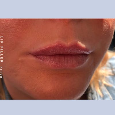 Non-Surgical Lips Before & After Gallery - Patient 108744408 - Image 2