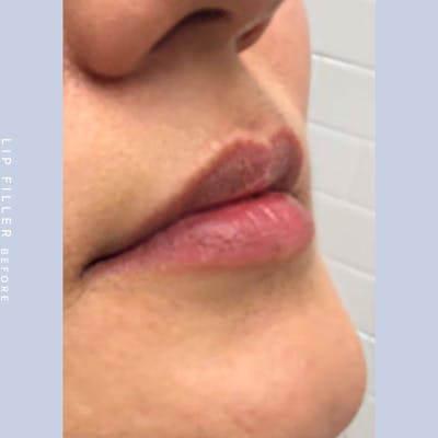 Non-Surgical Lips Before & After Gallery - Patient 108744409 - Image 1