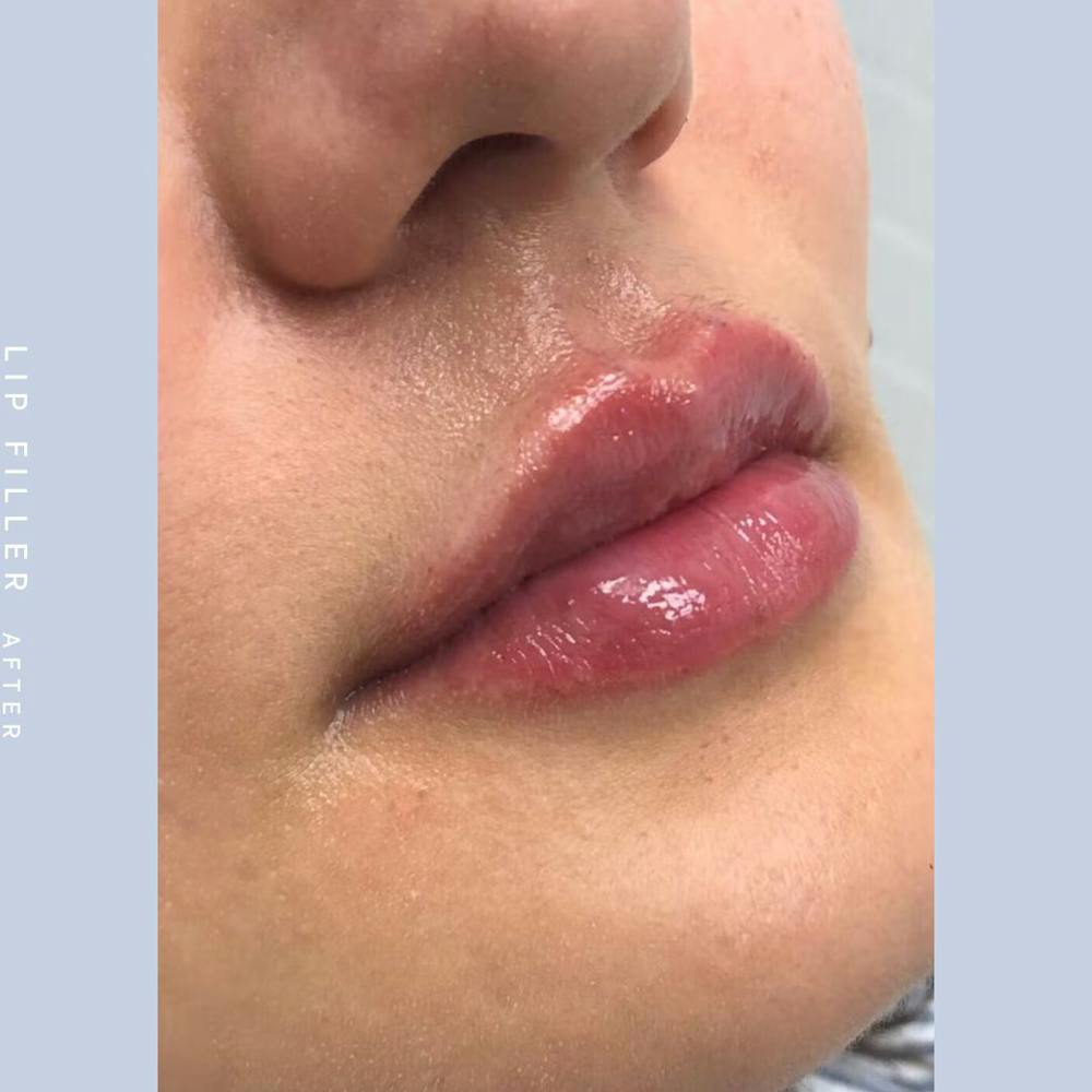 Non-Surgical Lips Before & After Gallery - Patient 108744409 - Image 2