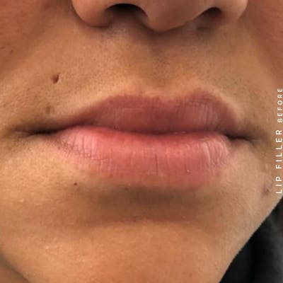 Non-Surgical Lips Before & After Gallery - Patient 108744410 - Image 1