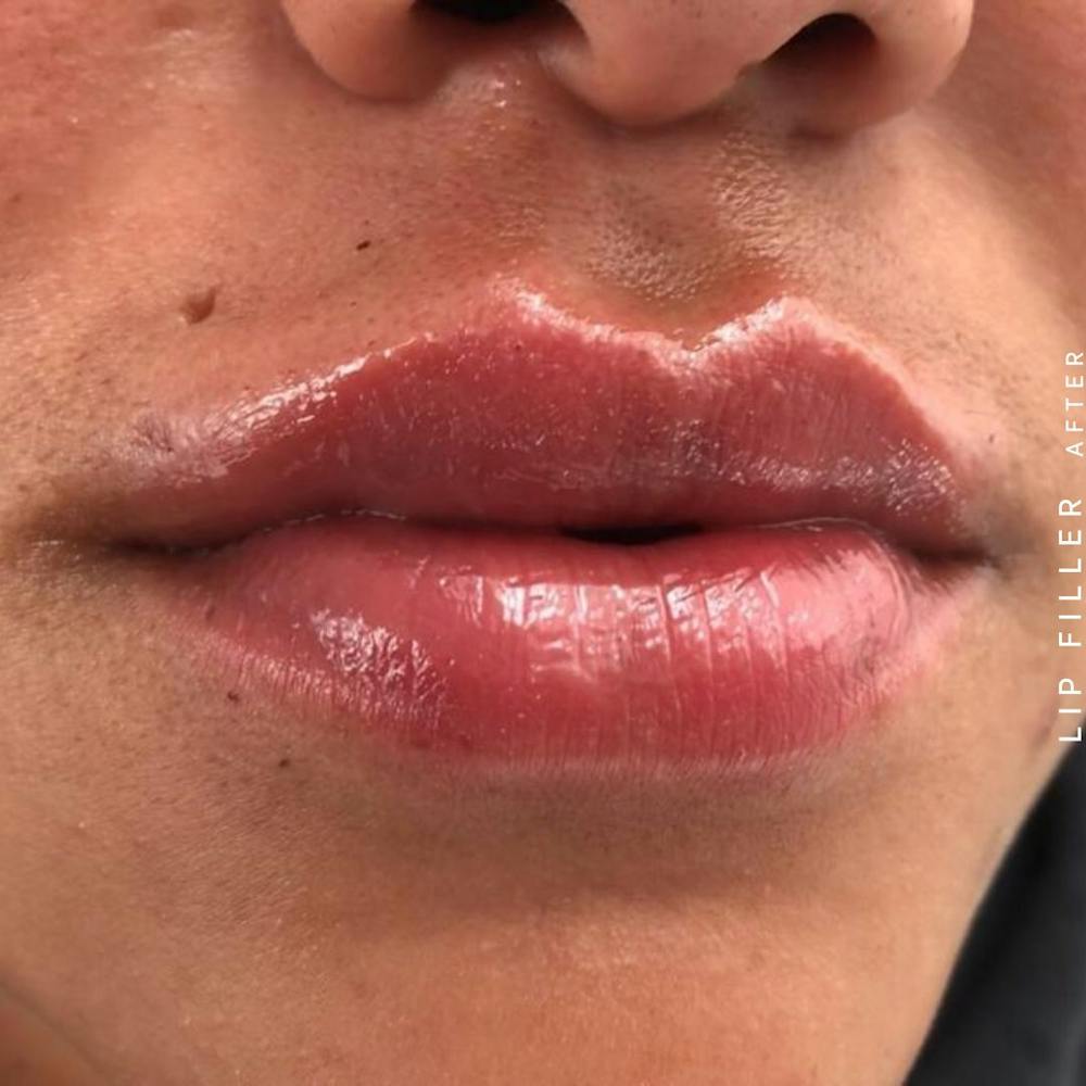 Non-Surgical Lips Before & After Gallery - Patient 108744410 - Image 2