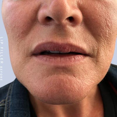 Non-Surgical Lips Before & After Gallery - Patient 108744411 - Image 1