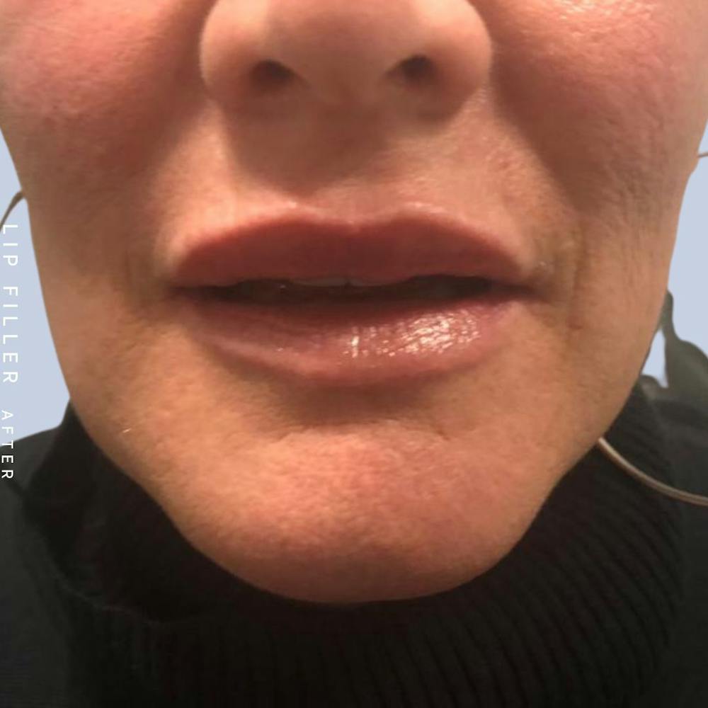 Non-Surgical Lips Before & After Gallery - Patient 108744411 - Image 2