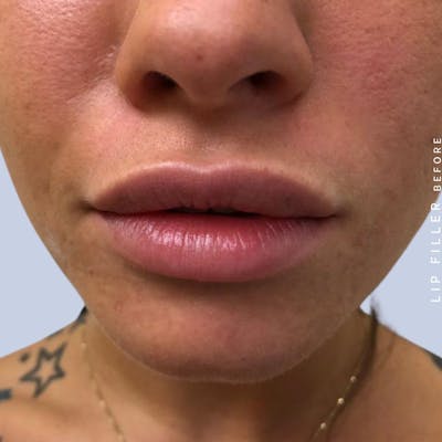 Non-Surgical Lips Before & After Gallery - Patient 108744412 - Image 1