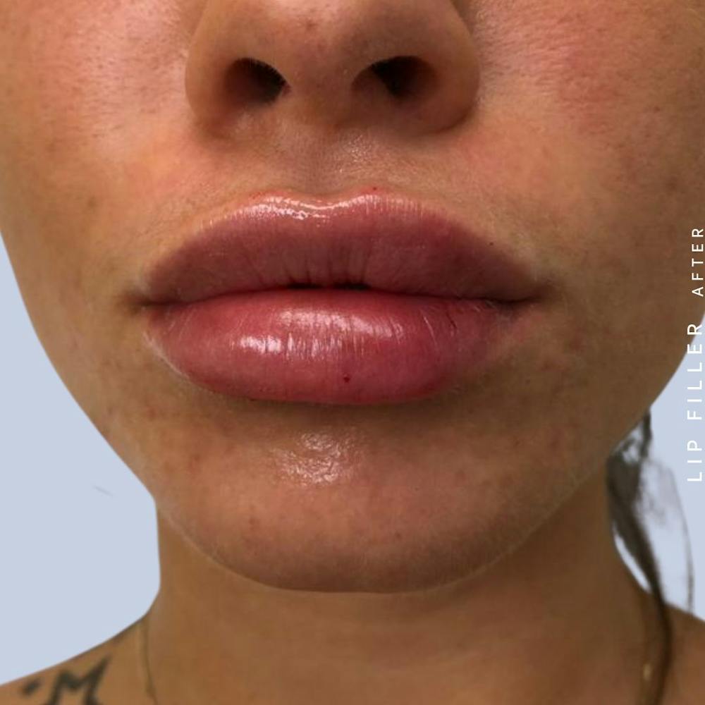 Non-Surgical Lips Before & After Gallery - Patient 108744412 - Image 2