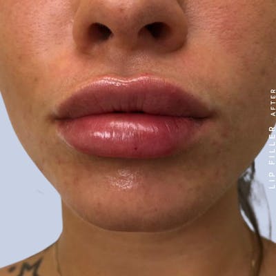 Lips Before & After Gallery - Patient 108744412 - Image 2