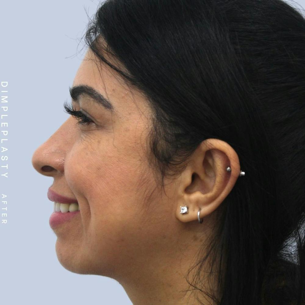 Dimpleplasty Before & After Gallery - Patient 108744127 - Image 4
