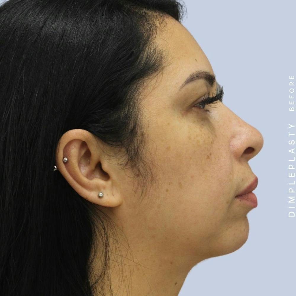 Dimpleplasty Before & After Gallery - Patient 108744127 - Image 5