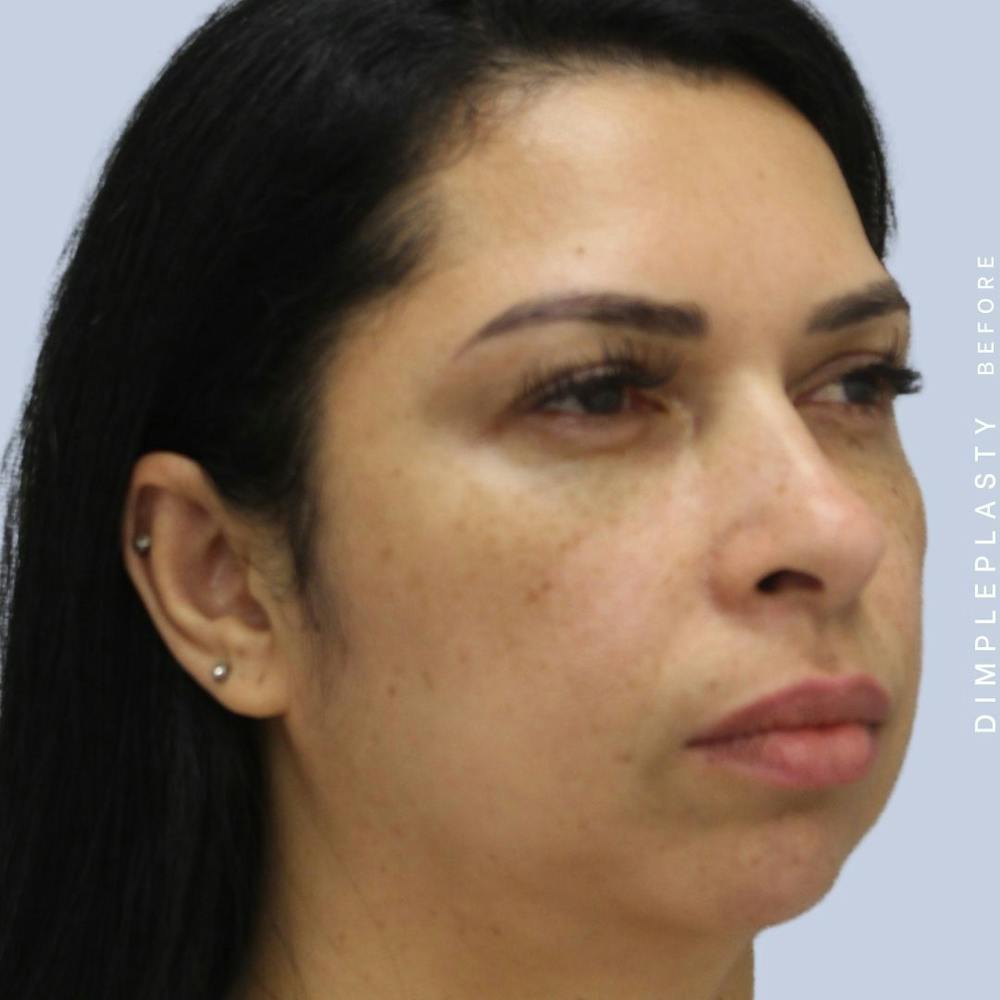 Dimpleplasty Before & After Gallery - Patient 108744127 - Image 7