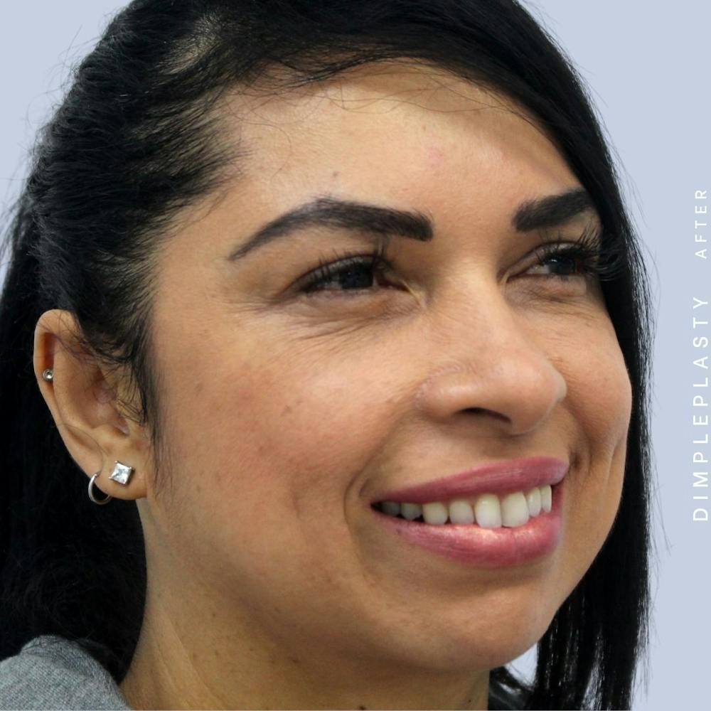 Dimpleplasty Before & After Gallery - Patient 108744127 - Image 8