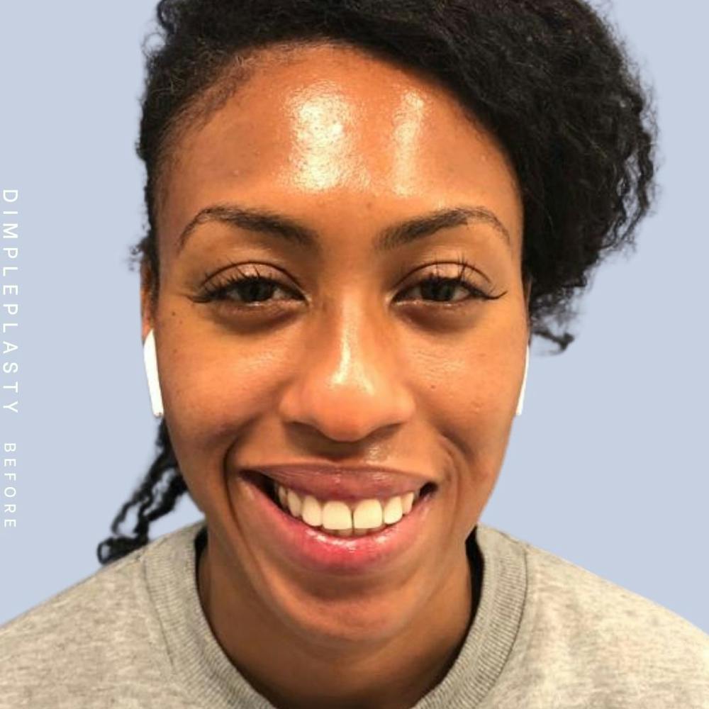 Dimpleplasty Before & After Gallery - Patient 120896267 - Image 1
