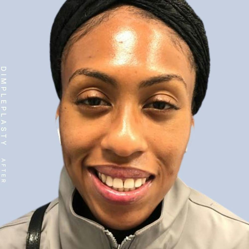 Dimpleplasty Before & After Gallery - Patient 120896267 - Image 2