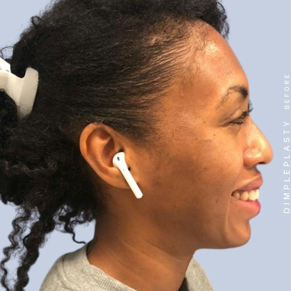 Dimpleplasty Before & After Gallery - Patient 120896267 - Image 3