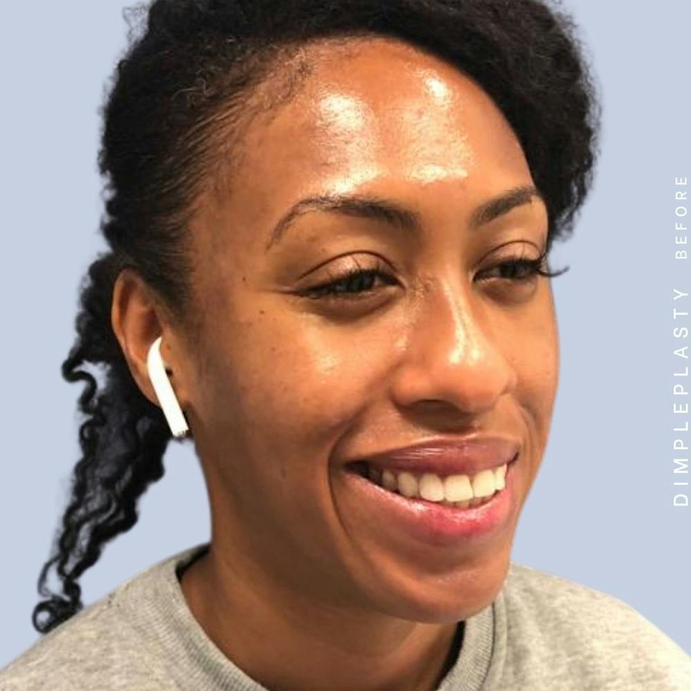 Dimpleplasty Before & After Gallery - Patient 120896267 - Image 5