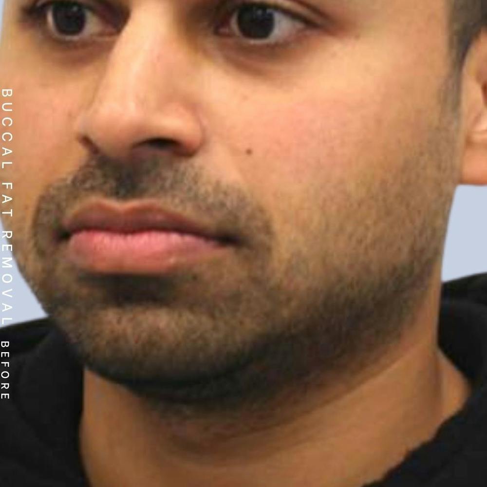 Buccal Fat Before & After Gallery - Patient 122053769 - Image 3