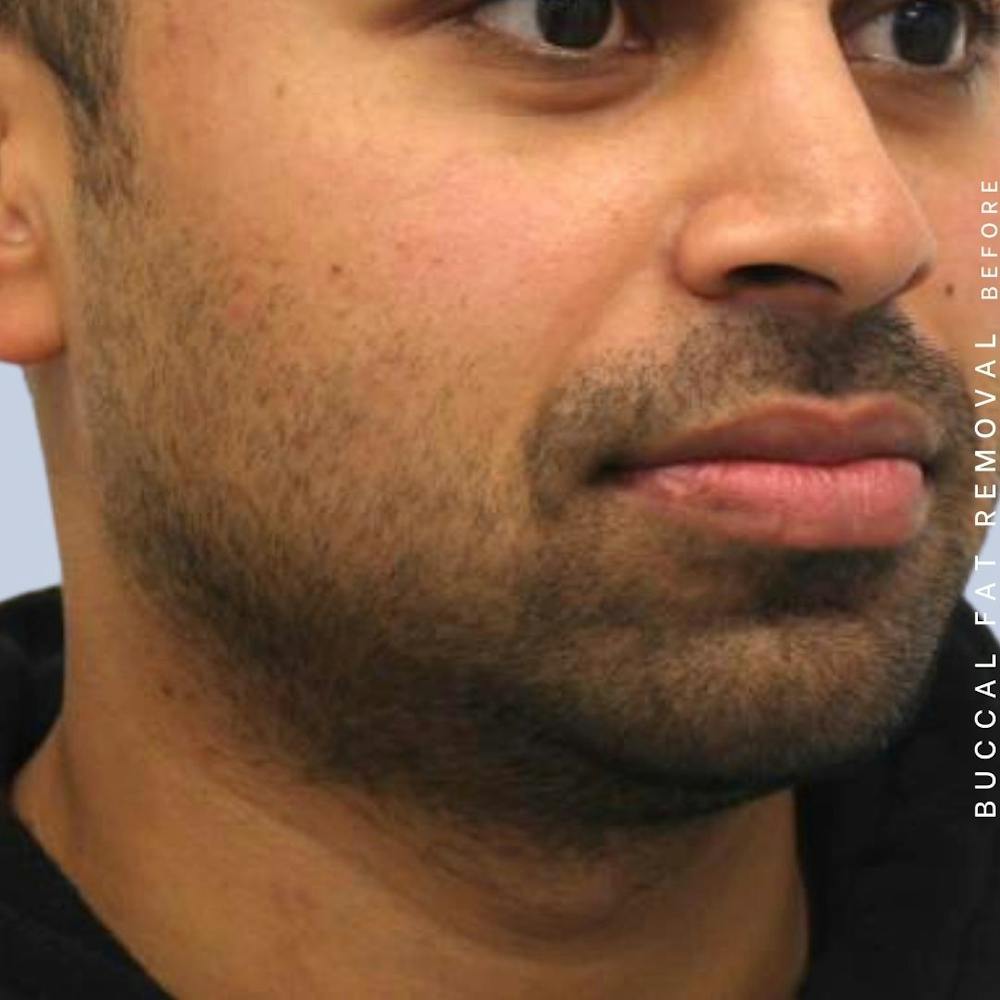 Buccal Fat Before & After Gallery - Patient 122053769 - Image 5