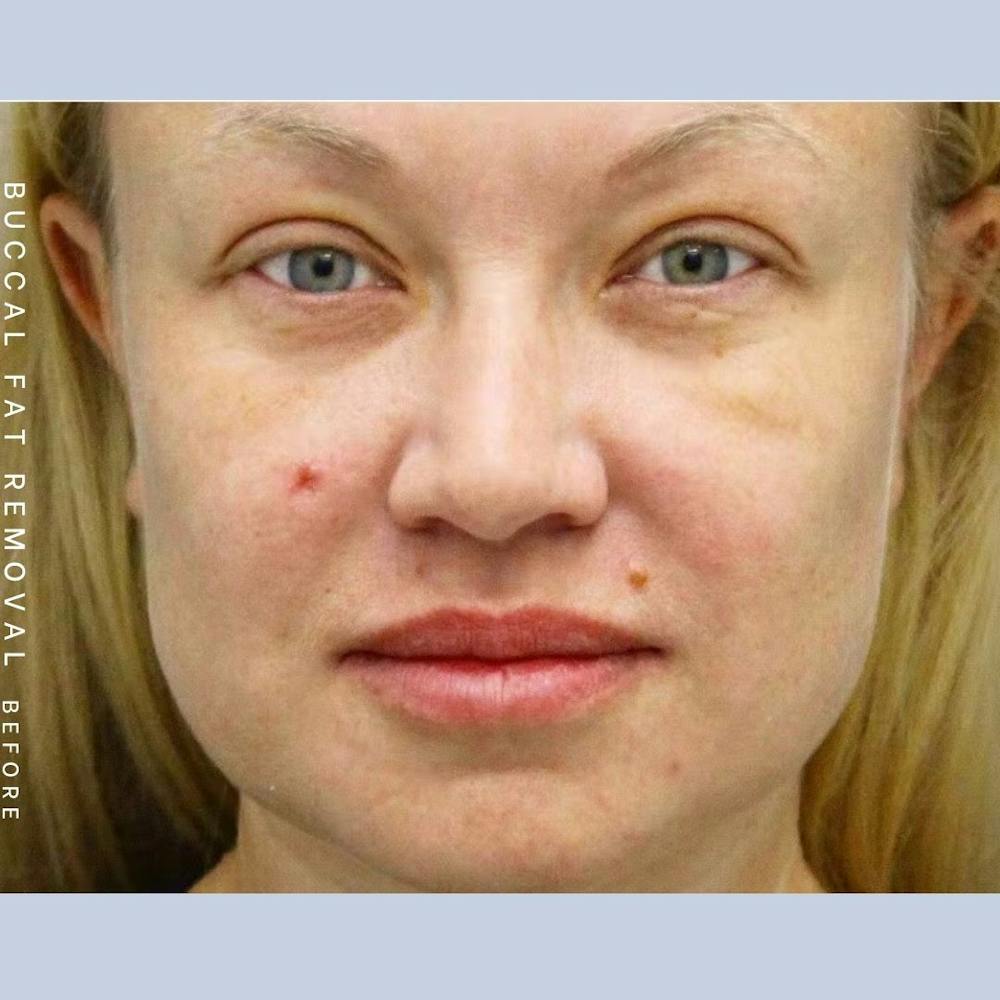 Buccal Fat Before & After Gallery - Patient 108744176 - Image 1