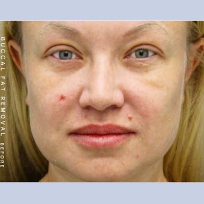 Buccal Fat Before & After Gallery - Patient 108744176 - Image 1