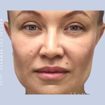 Buccal Fat Before & After Gallery - Patient 108744176 - Image 2