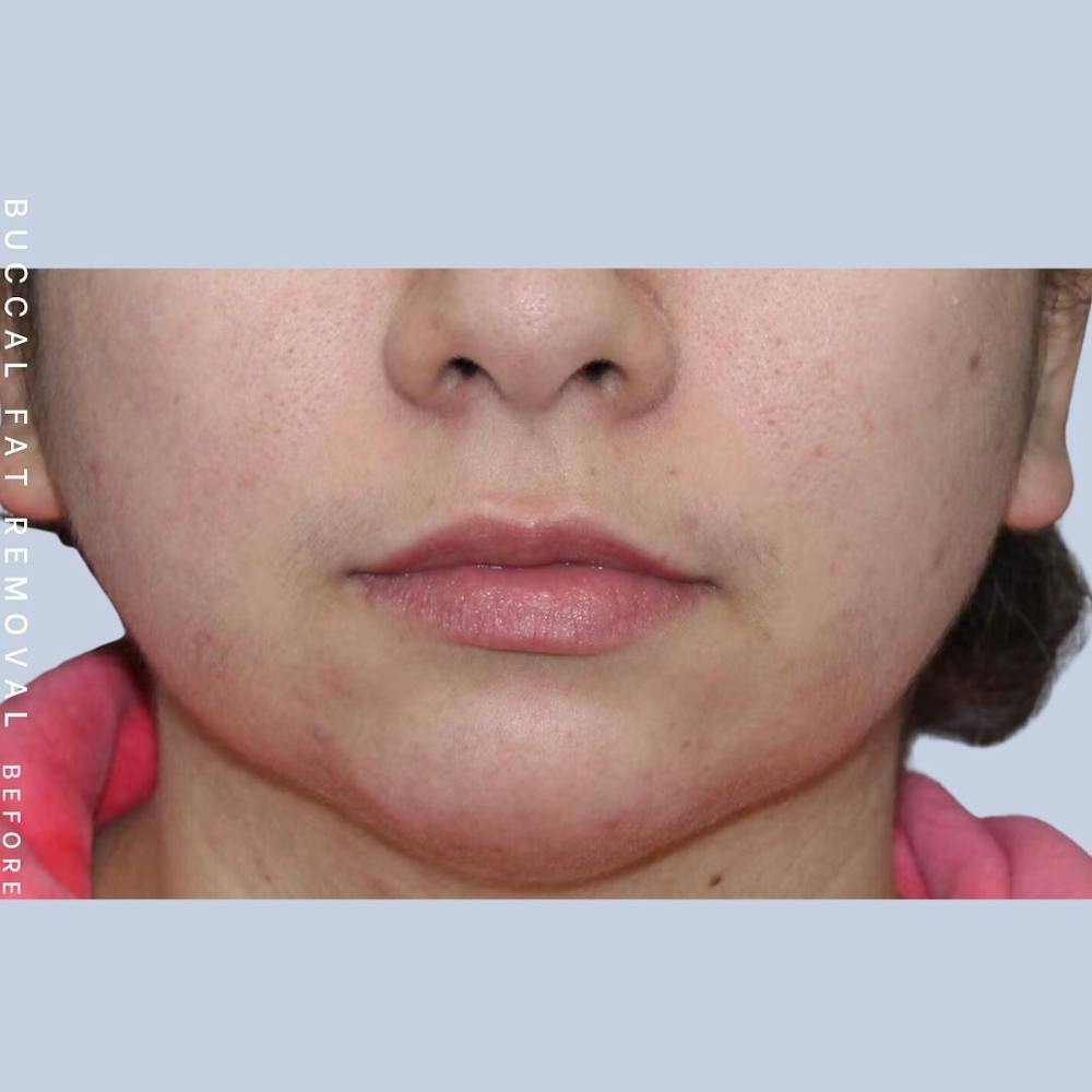 Buccal Fat Before & After Gallery - Patient 108744177 - Image 1