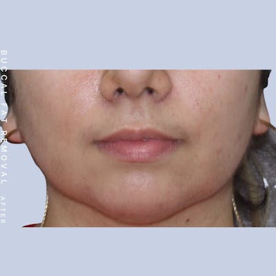 Buccal Fat Before & After Gallery - Patient 108744177 - Image 2