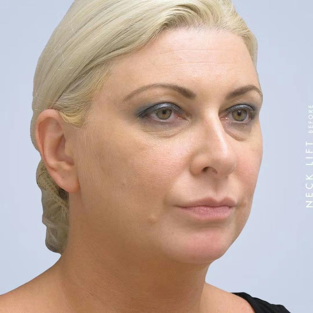 Chin Before & After Gallery - Patient 120145325 - Image 3